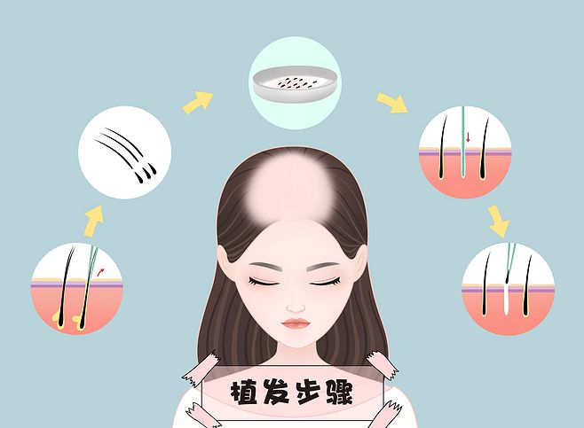 脱发头部健康脱发