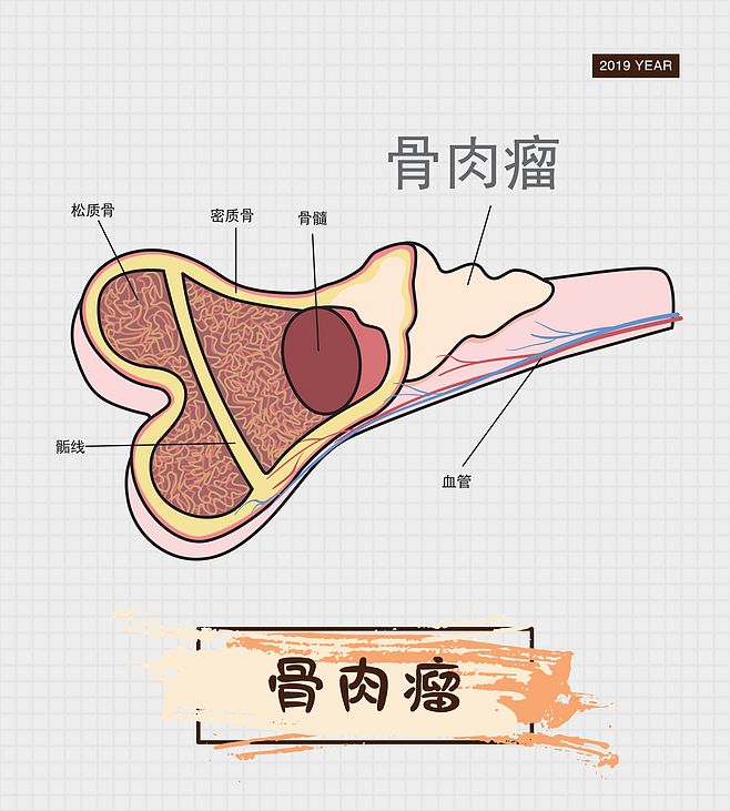 医疗肿瘤疾病骨肉瘤健康