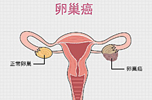 医疗生殖系统肿瘤、癌症、健康